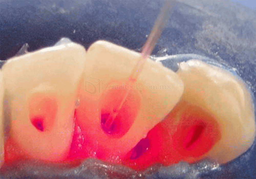 Láser de Diodo Odontológico Periodontales Láser de Tejidos Blandos Inalámbrico