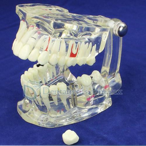ENOVO Modelo de restauración del implante & Demostración de enfermedad Dental
