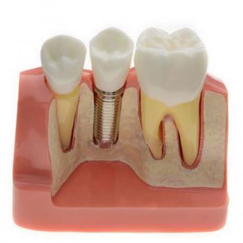 Modelo de Análisis implante corona dental M-2017