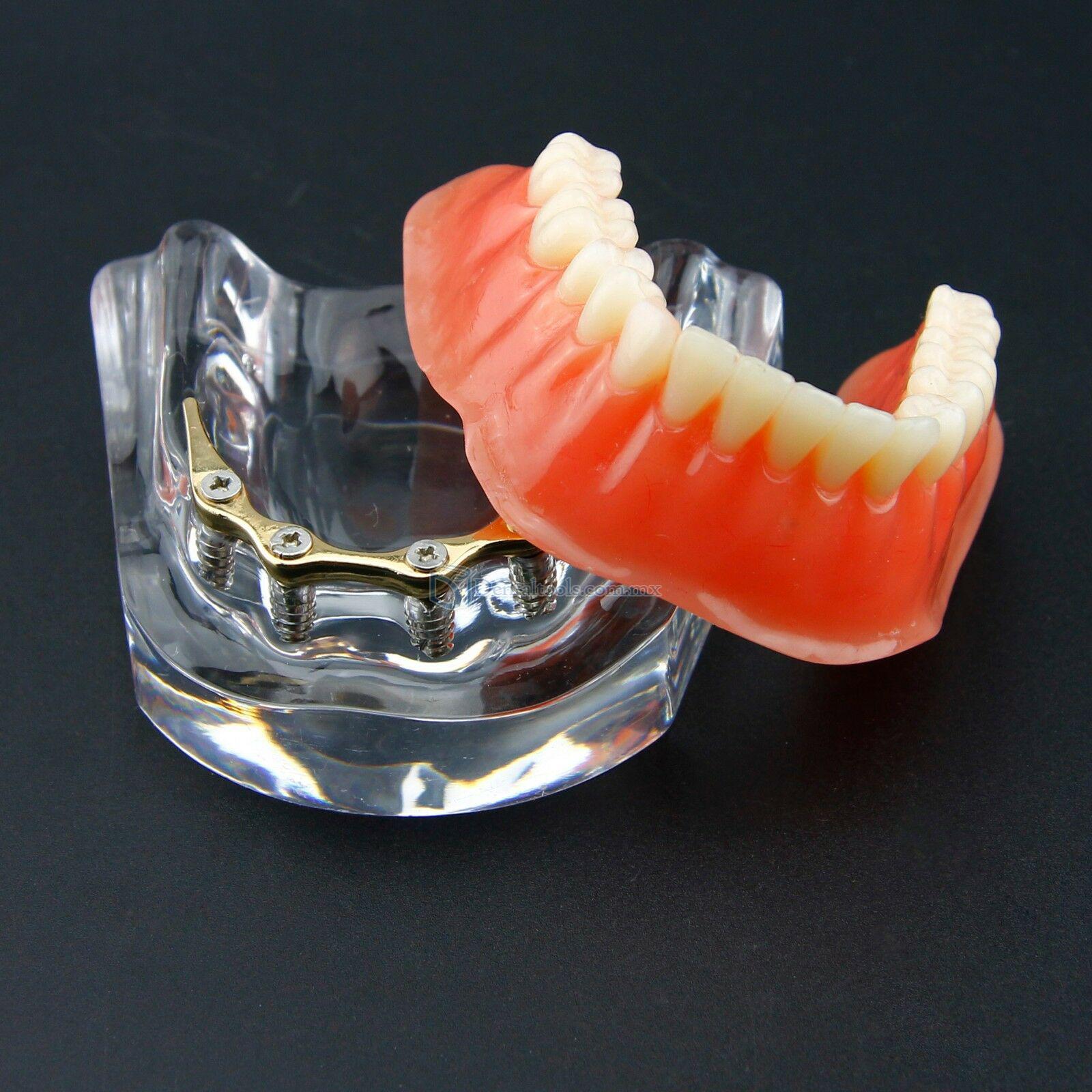 Dental Sobredentadura Typodont Modelo Inferior Precision Implant Dorado #6009
