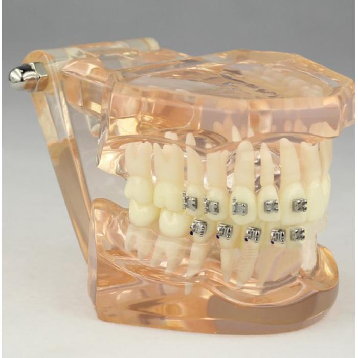 Modelo de ortodoncia con brackets cerámicos para demostración M3009