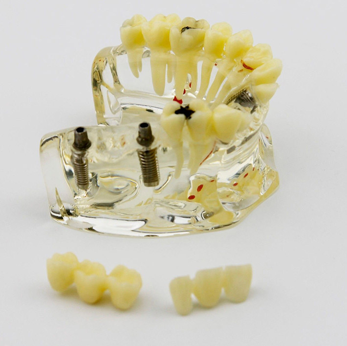 Modelo de demostración dental con implantes, puente y caries 2006