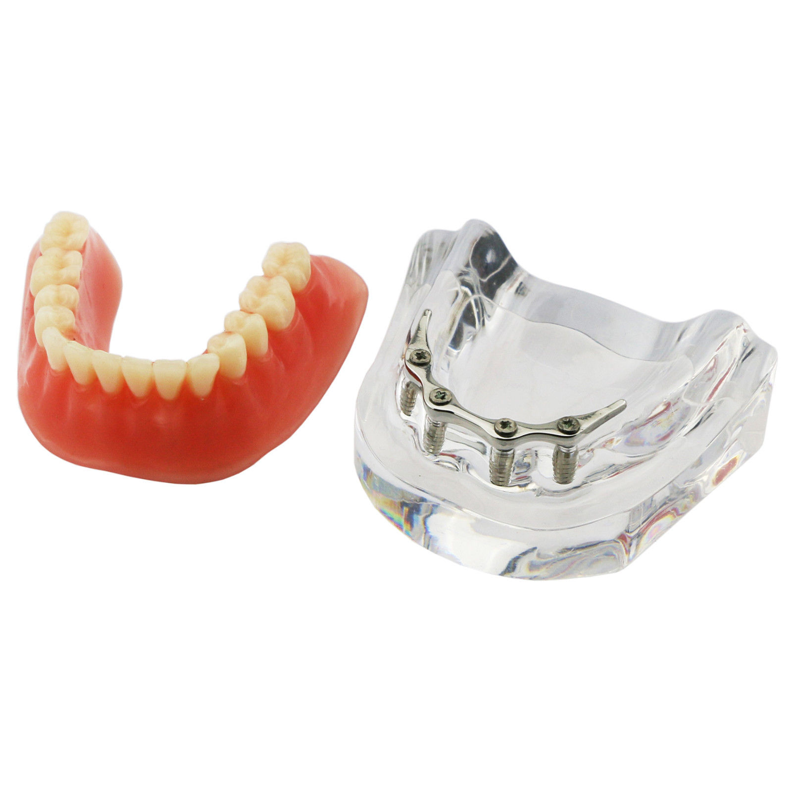Modelo dental de mandíbula con 4 implantes para demostración 6008
