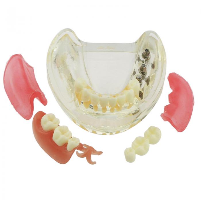Modelo mandibular de implantes dentales con puente removible para restauración 6006