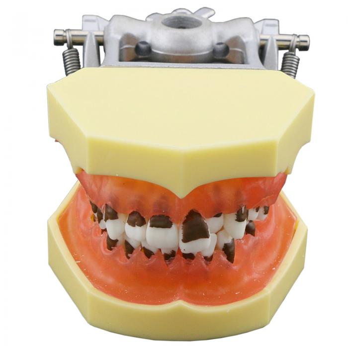 Modelo dental de enfermedad periodontal con encías inflamadas y cálculo dental 4003