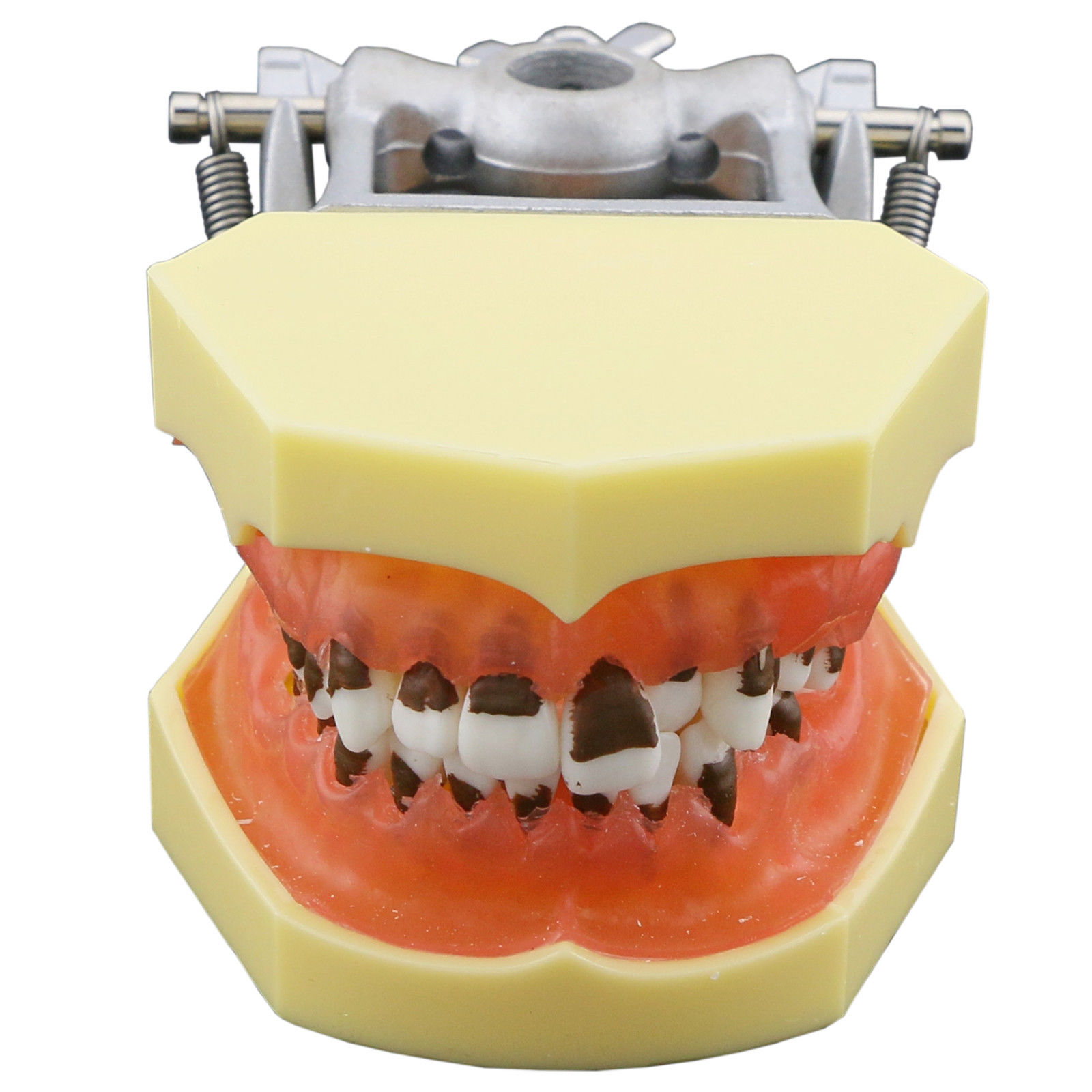 Modelo dental de enfermedad periodontal con encías inflamadas y cálculo dental 4003