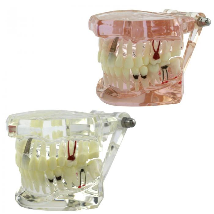 Modelo dental didáctico para demostración de implantes caries y enfermedad periodontal