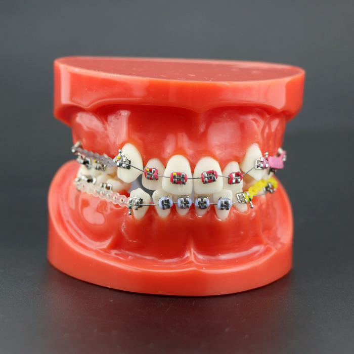Modelo de ortodoncia con brackets metálicos arco ligaduras y cadena elástica 3005R