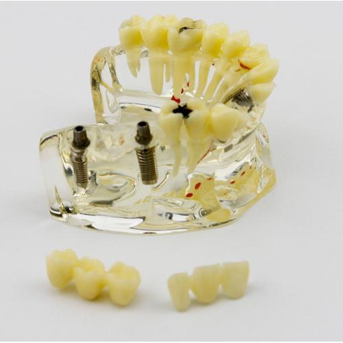 Modelo de demostración dental con implantes, puente y caries 2006