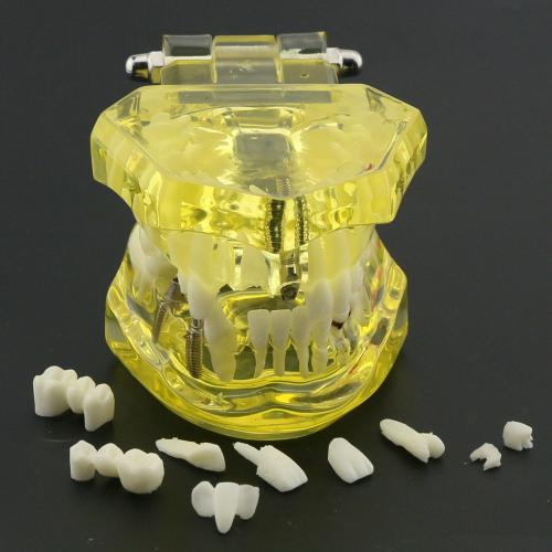 Modelo dental didáctico de implantes restauración y patologías en color amarillo 2001