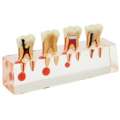 Modelo didáctico de endodoncia con 4 etapas del tratamiento de conductos 4018-01