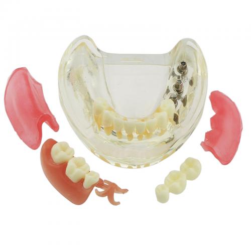 Modelo mandibular de implantes dentales con puente removible para restauración 6006