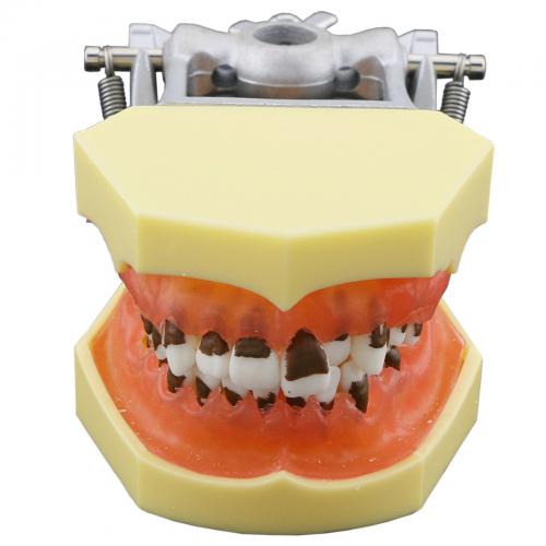 Modelo dental de enfermedad periodontal con encías inflamadas y cálculo dental 4003