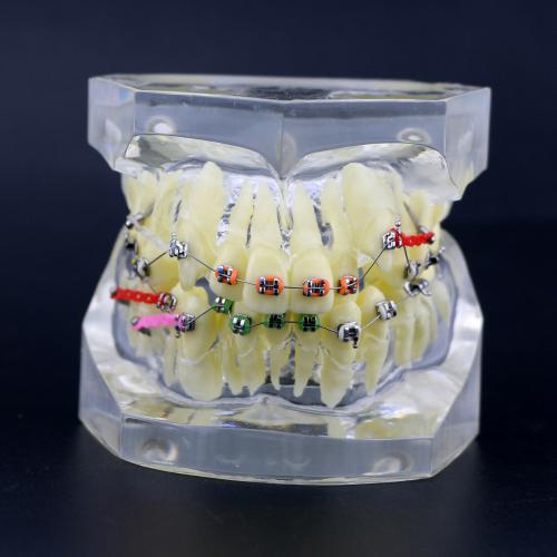Modelo de tratamiento de ortodoncia con brackets metálicos arcos ligaduras y cadena elástica