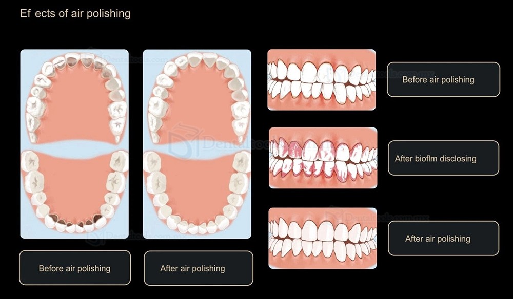 Woodpecker AP-H Plus Aeropulidor Dental Supragingival / Subgingival