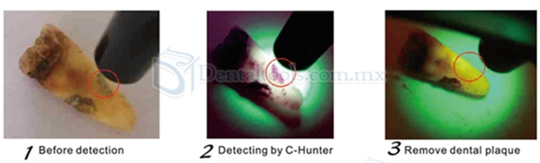 Dental Caries Detector C-Hunter