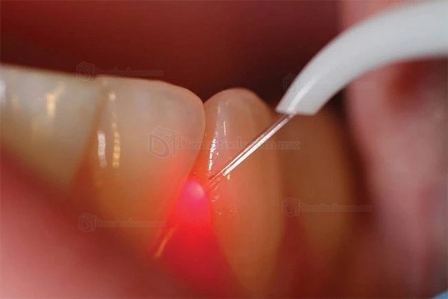 Láser de Tejido Blando Gigaa CHEESE Link Mini Láser de Diodo Dental 7W-10W 810/980nm