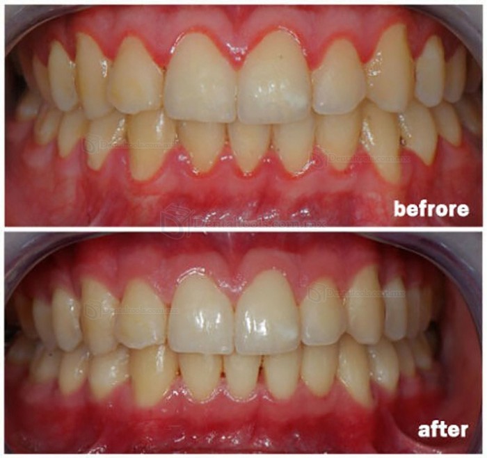 Láser de Diodo Odontológico Periodontales Láser de Tejidos Blandos Inalámbrico