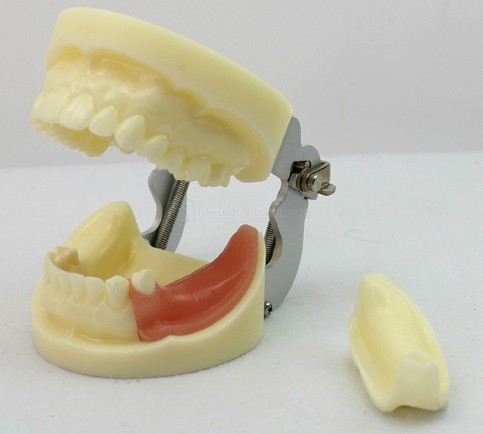 LENOVO Modelo de implante dental extraíble