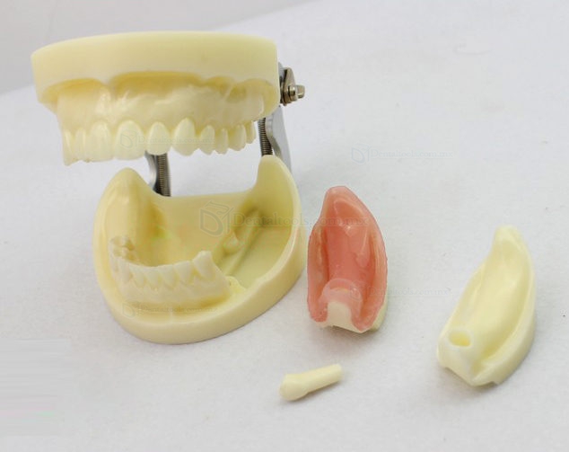 LENOVO Modelo de implante dental extraíble