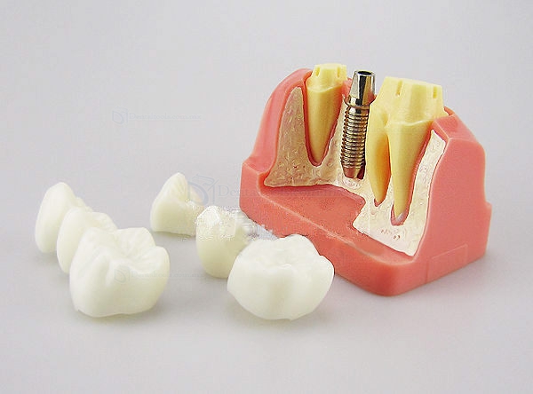 Modelo de Análisis implante corona dental M-2017