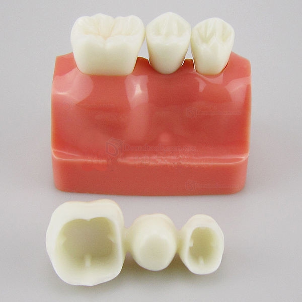 Modelo de Análisis implante corona dental M-2017
