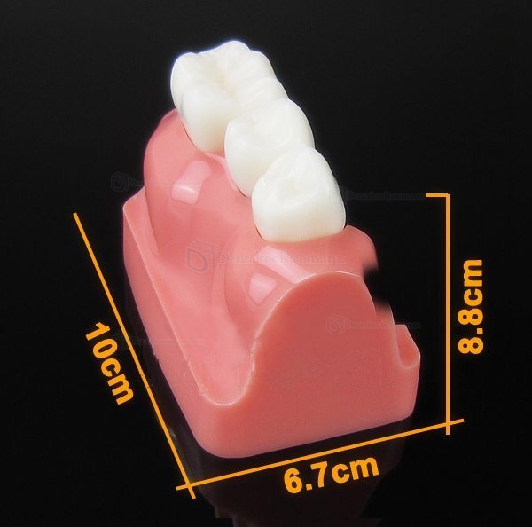 Modelo de Análisis implante corona dental M-2017