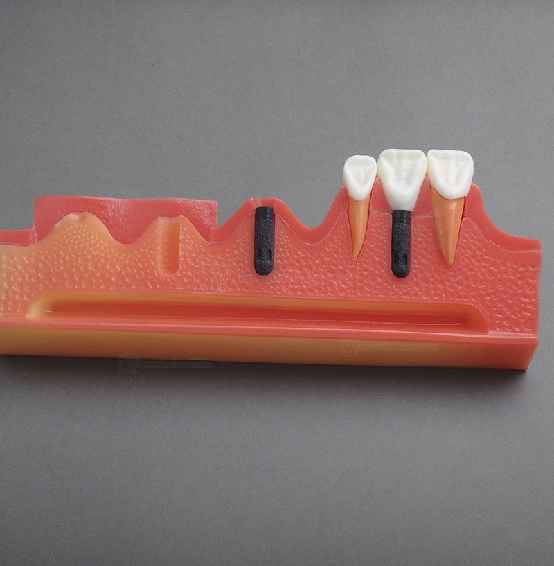 Modelo dental M-2018 etapas progresivas de un implante