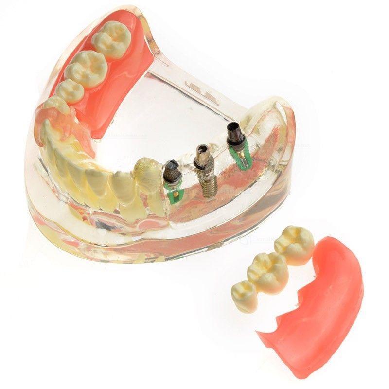 Modelo dental M-6006 Restauración de implantes