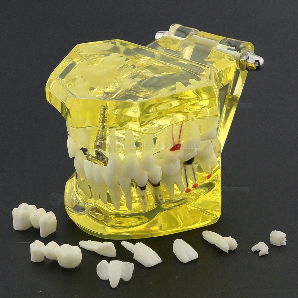 Modelo dental didáctico de implantes restauración y patologías en color amarillo 2001 Modelo dental didáctico de implantes restauración y patologías en color amarillo 2001