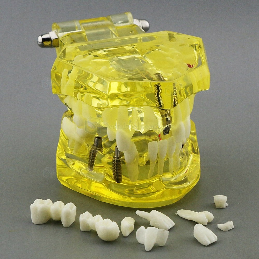 Modelo dental didáctico de implantes restauración y patologías en color amarillo 2001 Modelo dental didáctico de implantes restauración y patologías en color amarillo 2001