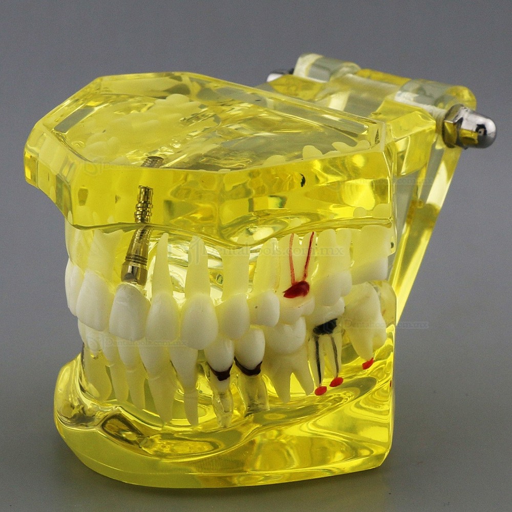 Modelo dental didáctico de implantes restauración y patologías en color amarillo 2001 Modelo dental didáctico de implantes restauración y patologías en color amarillo 2001