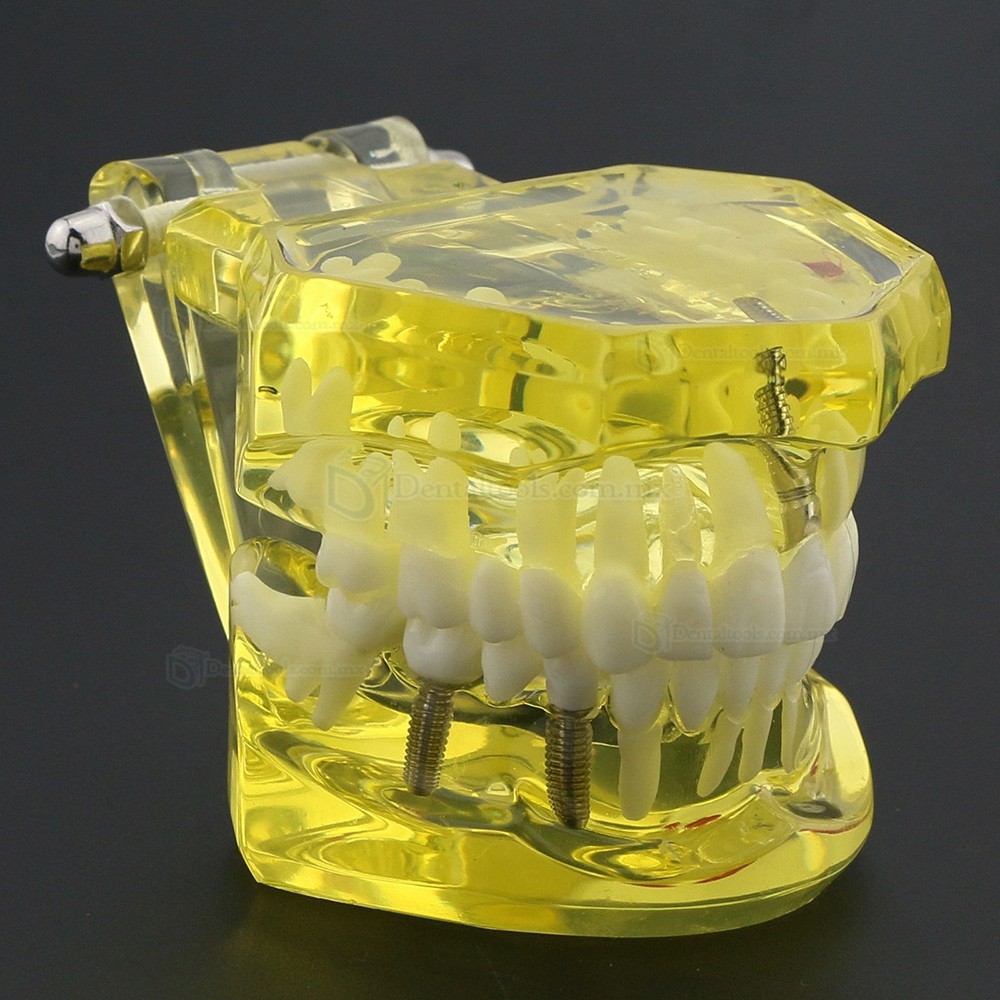 Modelo dental didáctico de implantes restauración y patologías en color amarillo 2001 Modelo dental didáctico de implantes restauración y patologías en color amarillo 2001