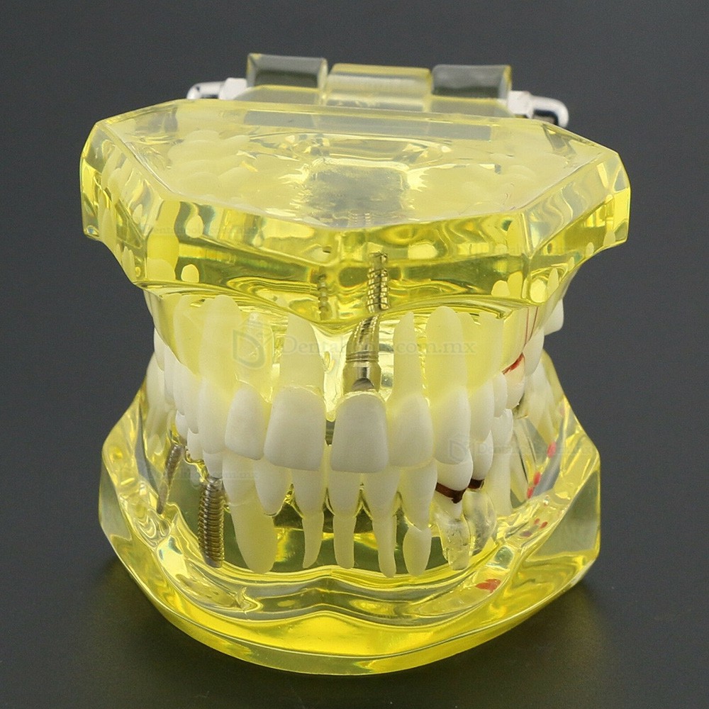 Modelo dental didáctico de implantes restauración y patologías en color amarillo 2001 Modelo dental didáctico de implantes restauración y patologías en color amarillo 2001