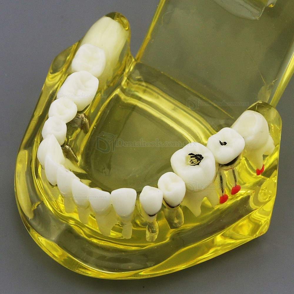 Modelo dental didáctico de implantes restauración y patologías en color amarillo 2001 Modelo dental didáctico de implantes restauración y patologías en color amarillo 2001