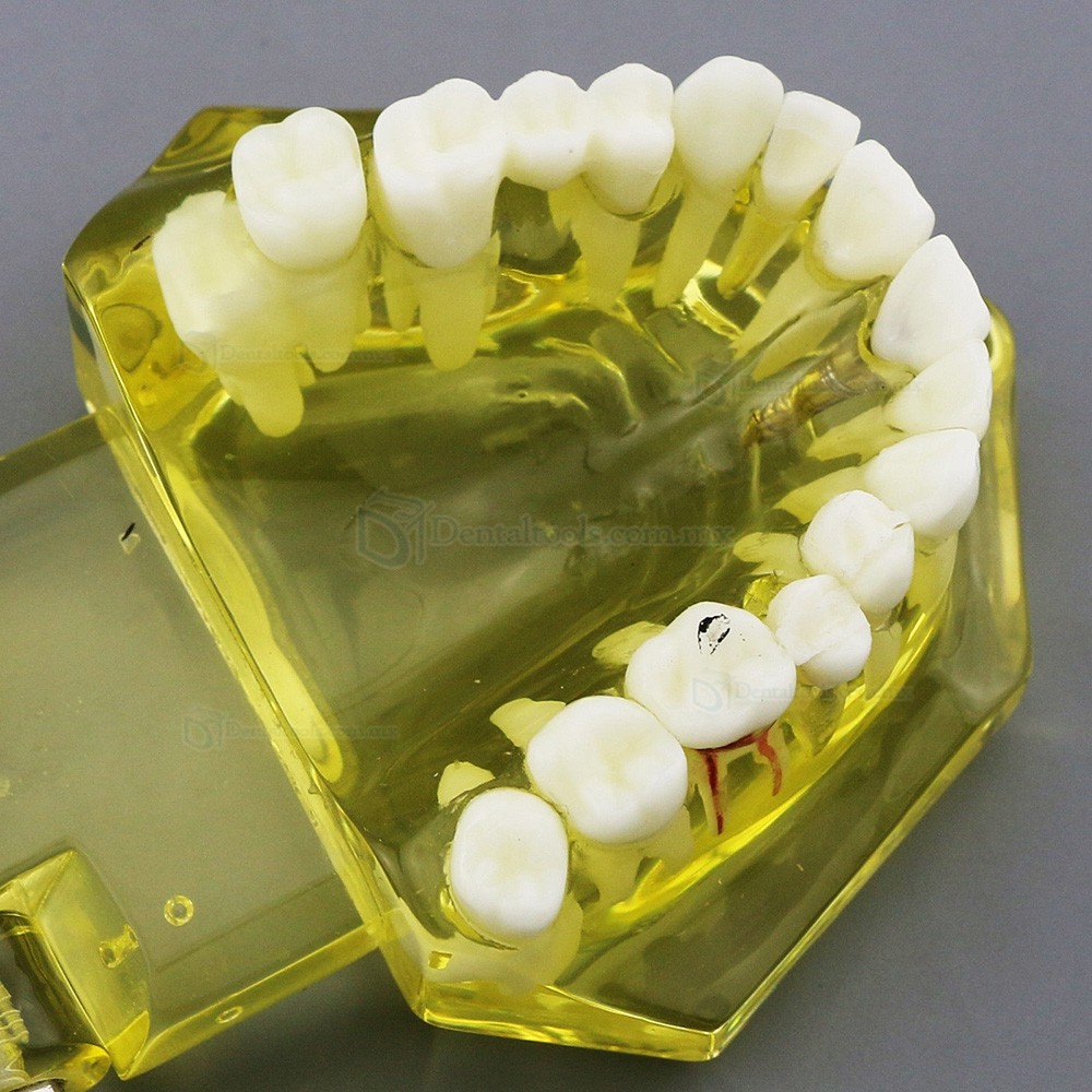 Modelo dental didáctico de implantes restauración y patologías en color amarillo 2001 Modelo dental didáctico de implantes restauración y patologías en color amarillo 2001