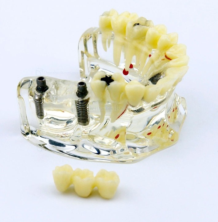 Modelo Modelo de demostración dental con implantes, puente y caries 2006