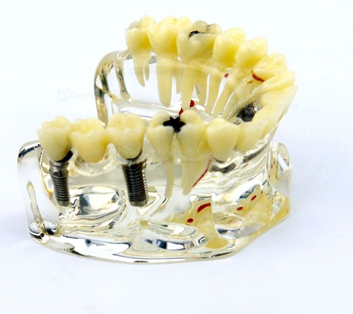Modelo de demostración dental con implantes, puente y caries 2006 Modelo de demostración dental con implantes, puente y caries 2006