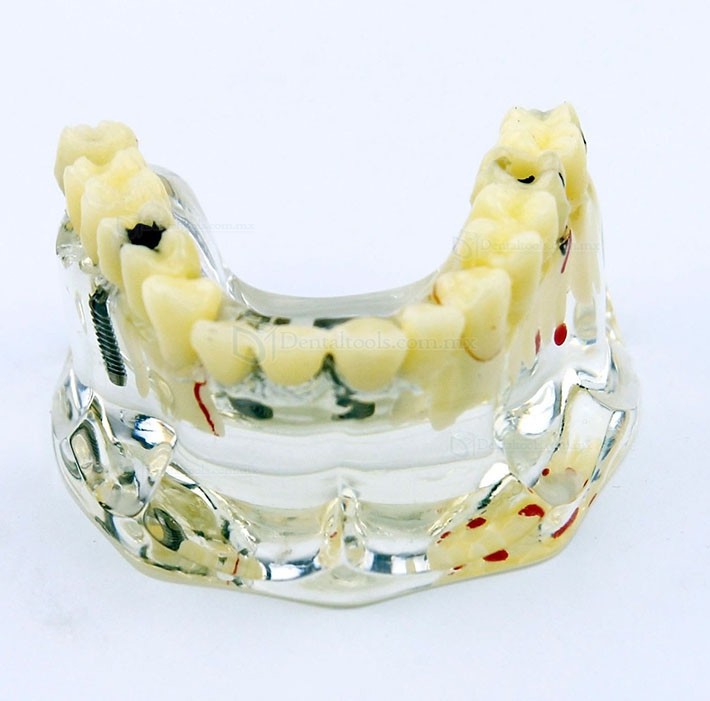 Modelo de demostración dental con implantes, puente y caries 2006 Modelo de demostración dental con implantes, puente y caries 2006
