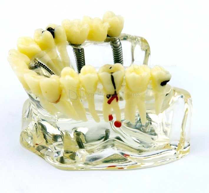Modelo de demostración dental con implantes, puente y caries 2006 Modelo de demostración dental con implantes, puente y caries 2006