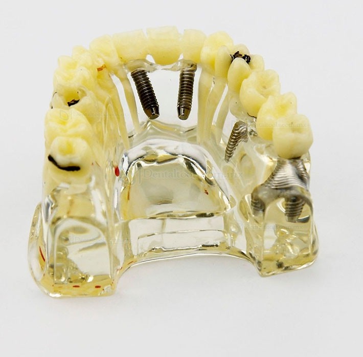Modelo de demostración dental con implantes, puente y caries 2006 Modelo de demostración dental con implantes, puente y caries 2006