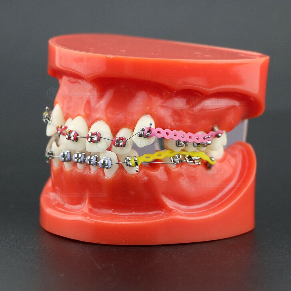 Modelo de ortodoncia con brackets metálicos arco ligaduras y cadena elástica 3005R Modelo de ortodoncia con brackets metálicos arco ligaduras y cadena elástica 3005R
