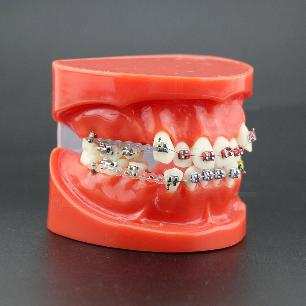 Modelo de ortodoncia con brackets metálicos arco ligaduras y cadena elástica 3005R Modelo de ortodoncia con brackets metálicos arco ligaduras y cadena elástica 3005R