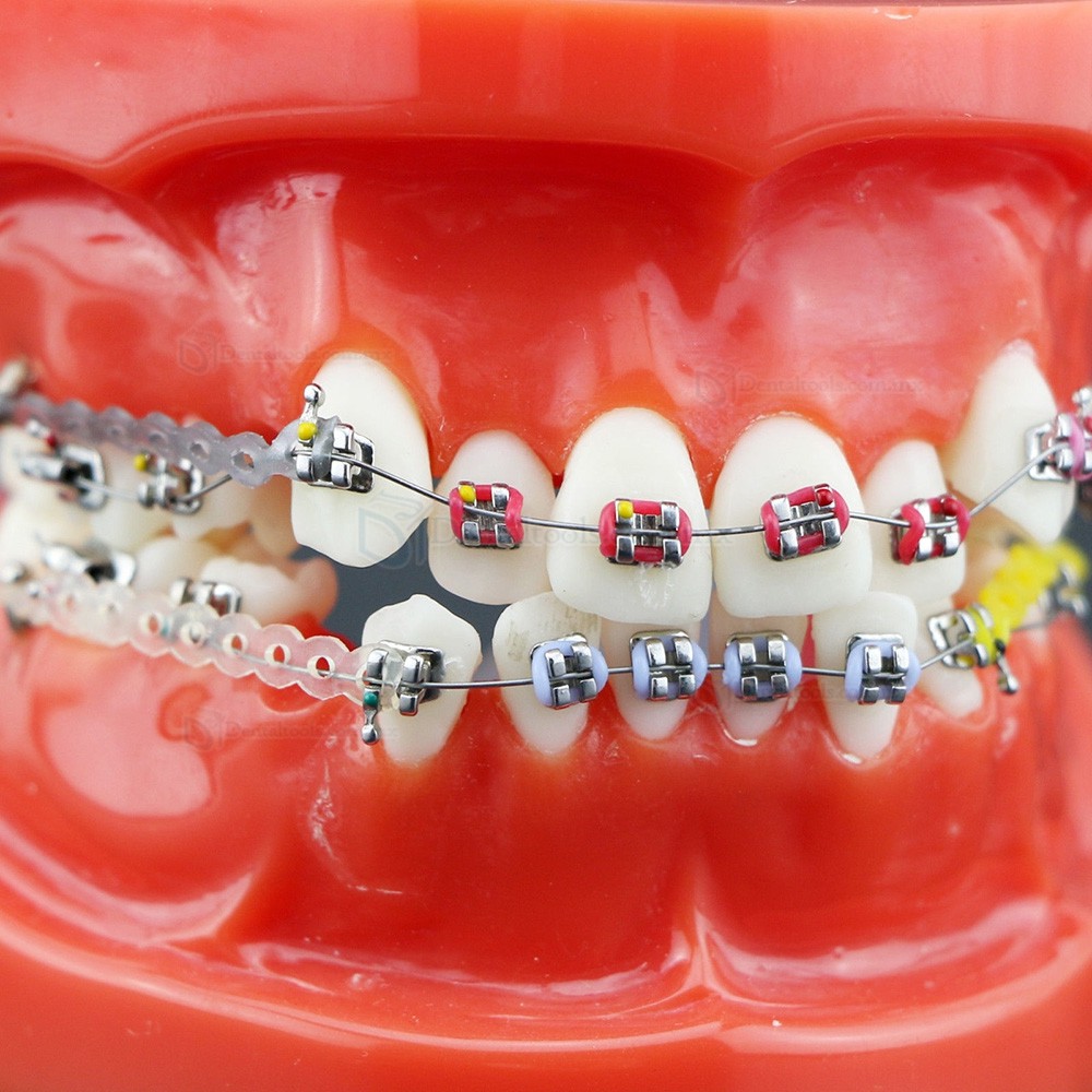 Modelo de ortodoncia con brackets metálicos arco ligaduras y cadena elástica 3005R Modelo de ortodoncia con brackets metálicos arco ligaduras y cadena elástica 3005R