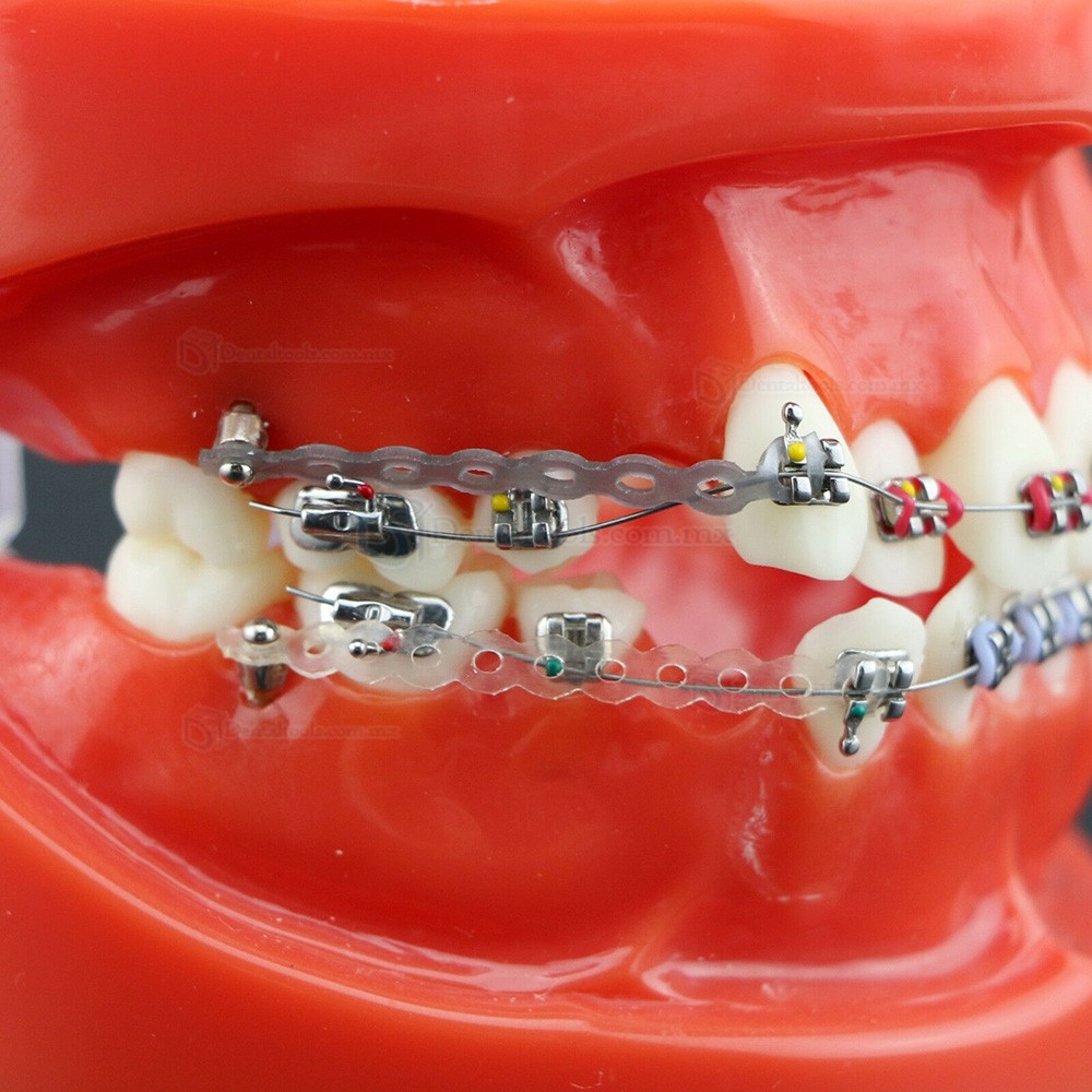 Modelo de ortodoncia con brackets metálicos arco ligaduras y cadena elástica 3005R Modelo de ortodoncia con brackets metálicos arco ligaduras y cadena elástica 3005R