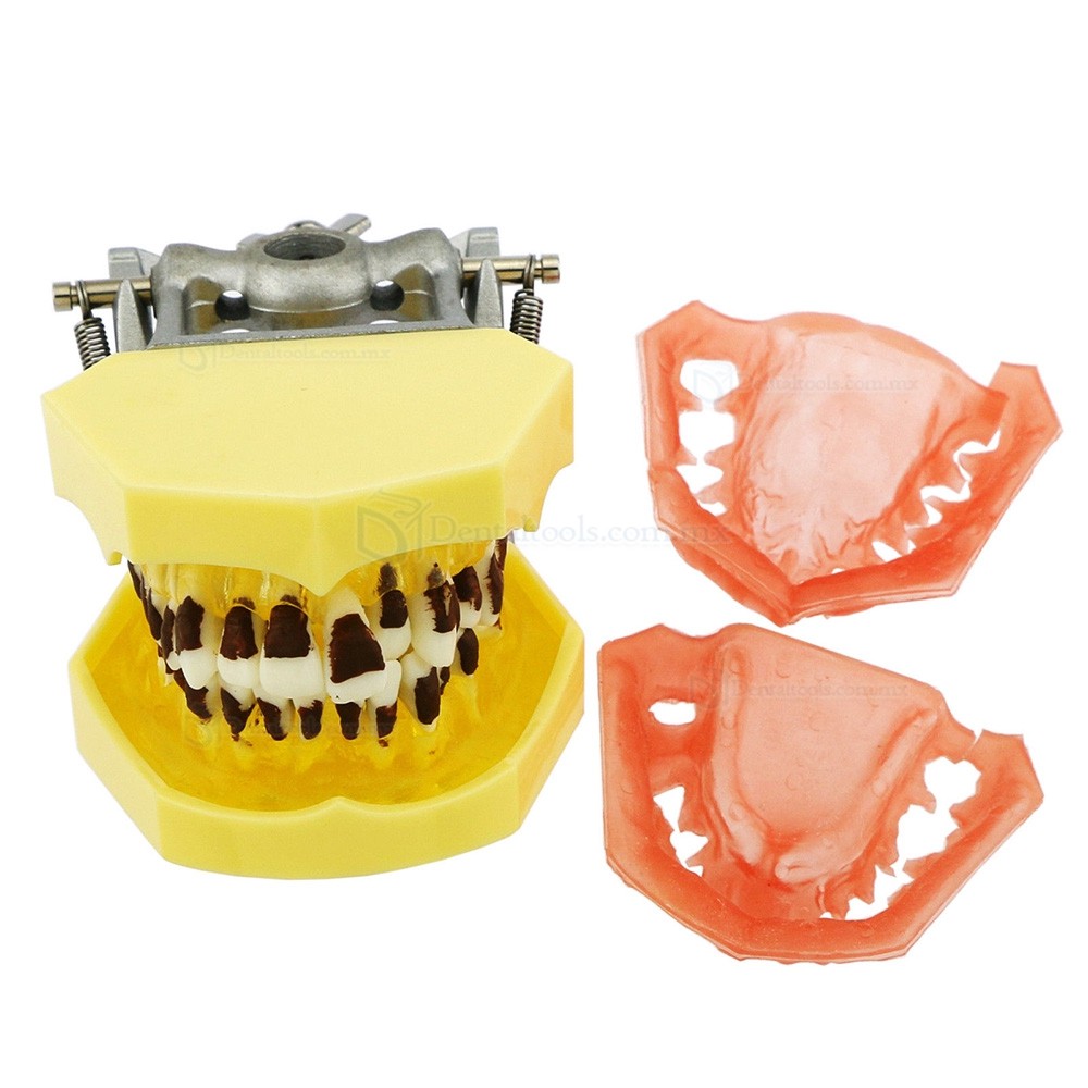 Modelo dental de enfermedad periodontal con enc&iacute;as inflamadas y c&aacute;lculo dental 4003