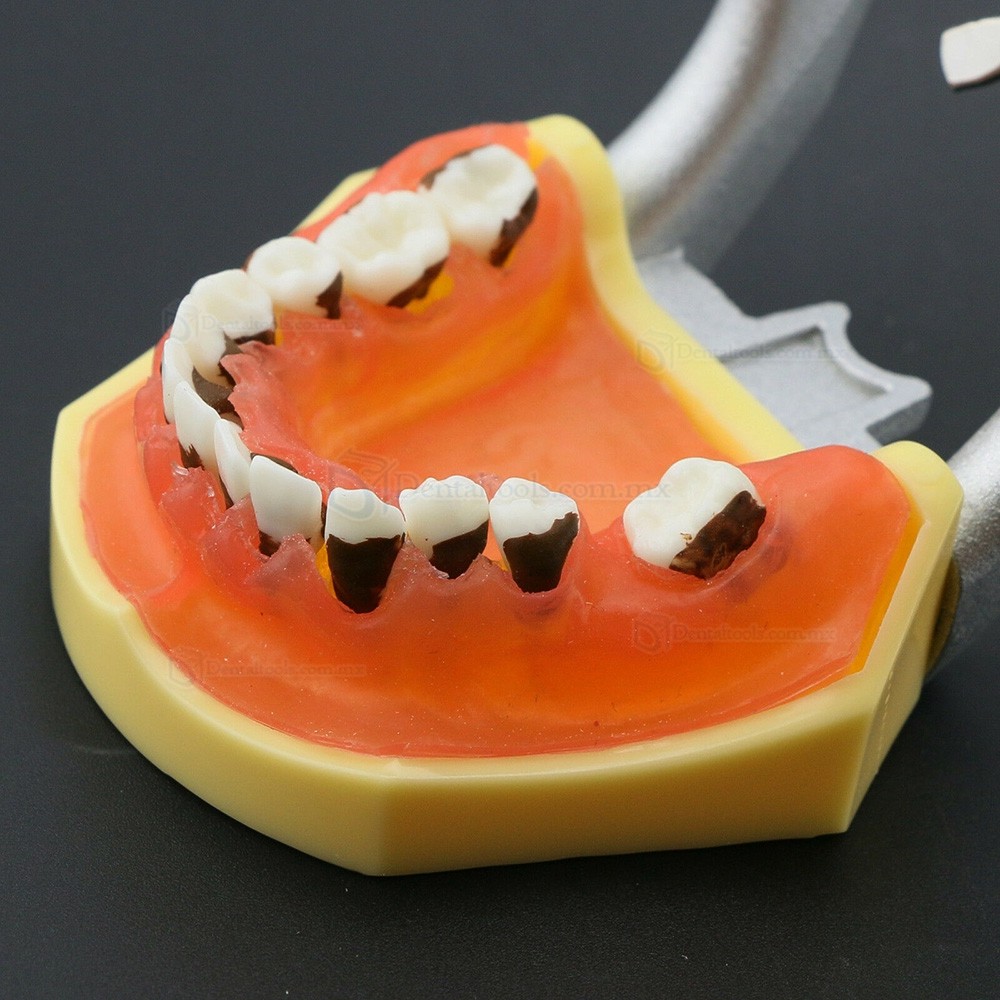 Modelo dental de enfermedad periodontal con enc&iacute;as inflamadas y c&aacute;lculo dental 4003