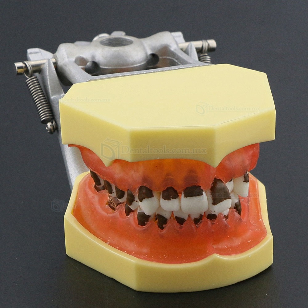 Modelo dental de enfermedad periodontal con enc&iacute;as inflamadas y c&aacute;lculo dental 4003