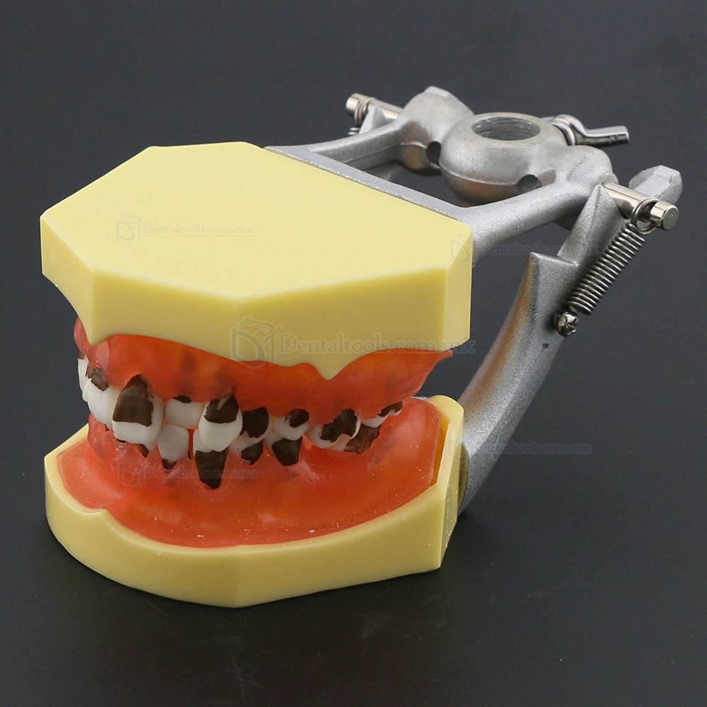 Modelo dental de enfermedad periodontal con enc&iacute;as inflamadas y c&aacute;lculo dental 4003