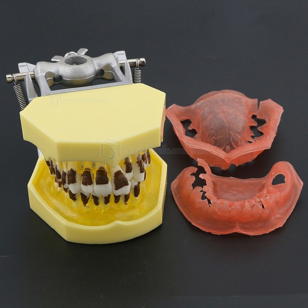 Modelo dental de enfermedad periodontal con enc&iacute;as inflamadas y c&aacute;lculo dental 4003